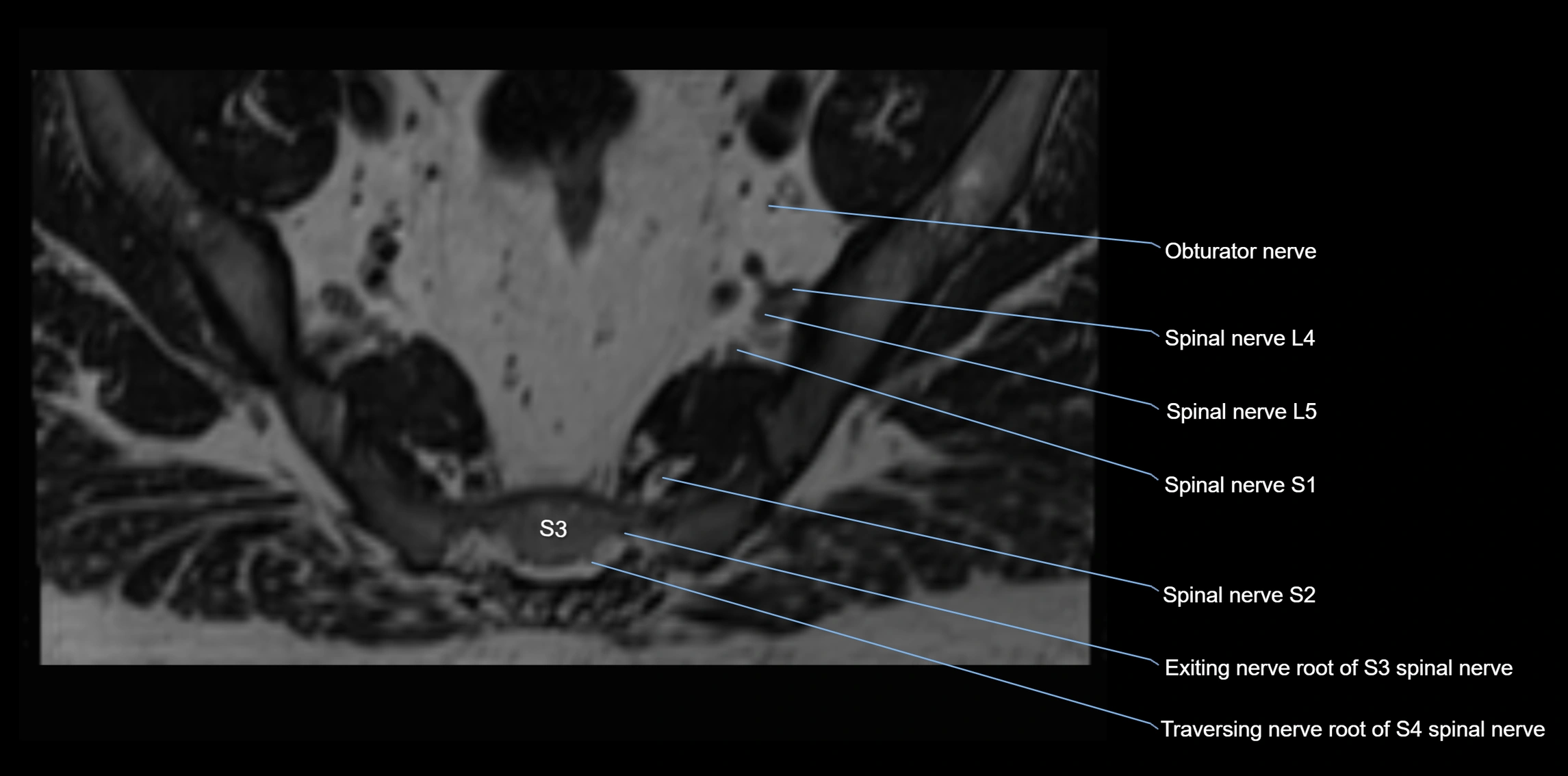 MR lumbosacral plexus axial cross sectional anatomy 3T  radiology  image-img-1008001-00092.webp